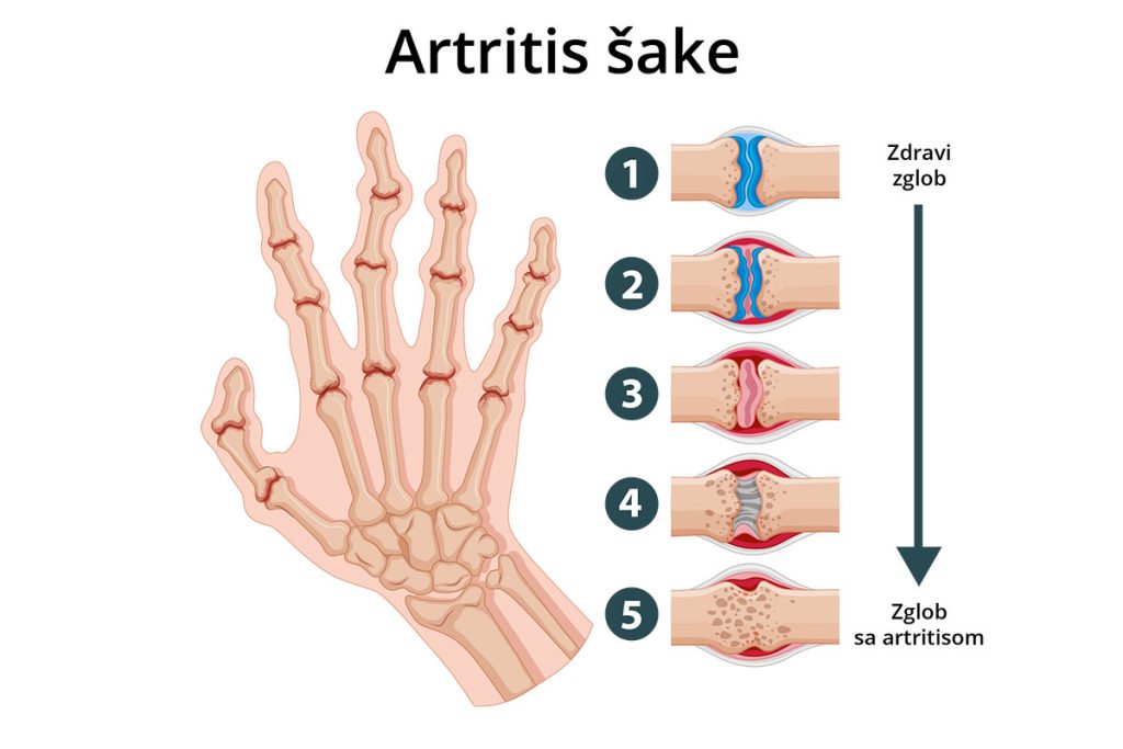Artritis šake - ilustracija