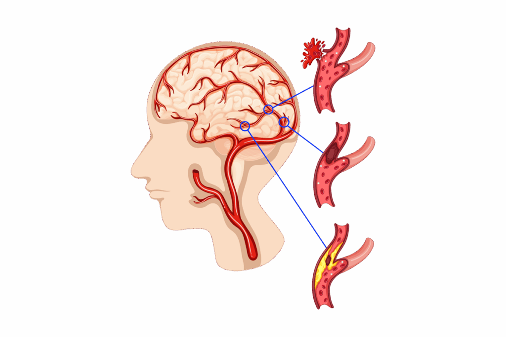 Moždani udar - ilustracija